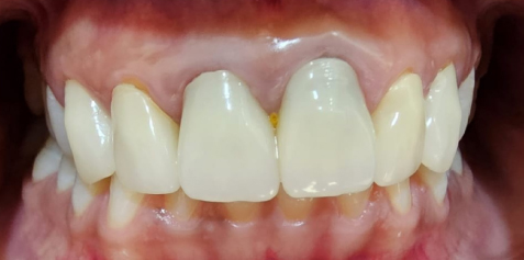 01-AFTER Hollywood Smile Veneers in Dubai - Dr. Vesna Markovic Mrdak Best Dentist