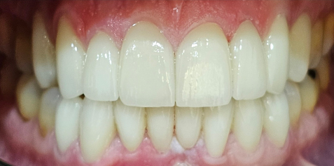 02-AFTER Hollywood Smile Veneers - Dr. Vesna Markovic Mrdak Best Cosmetic Dentist in Dubai