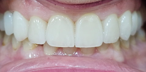 03-AFTER Hollywood Smile Dental Clinic - Dr. Vesna Markovic Mrdak Best Hollywood Smile Dentist in Dubai