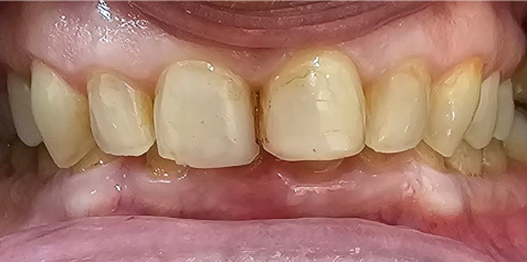 03-BEFORE Hollywood Smile Dental Clinic - Dr. Vesna Markovic Mrdak Best Hollywood Smile Dentist in Dubai